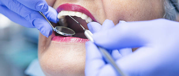 Best Knocked-Out Tooth (Avulsed Tooth) Treatment in West Branch, MI